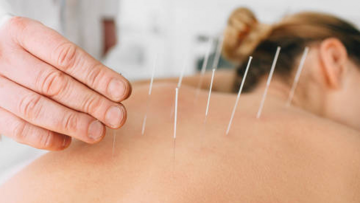 Get Relief from Pain with Acupuncture Treatment