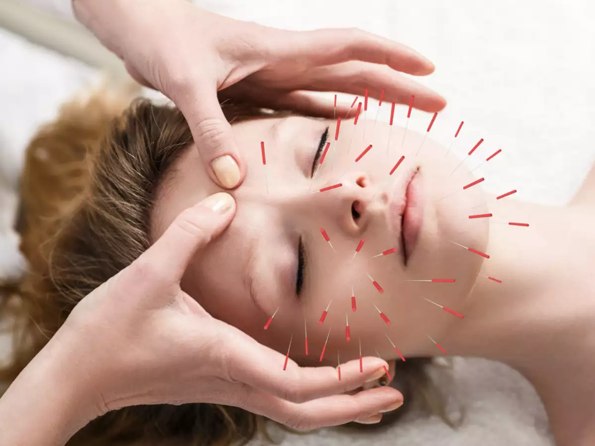 acupuncture treatment