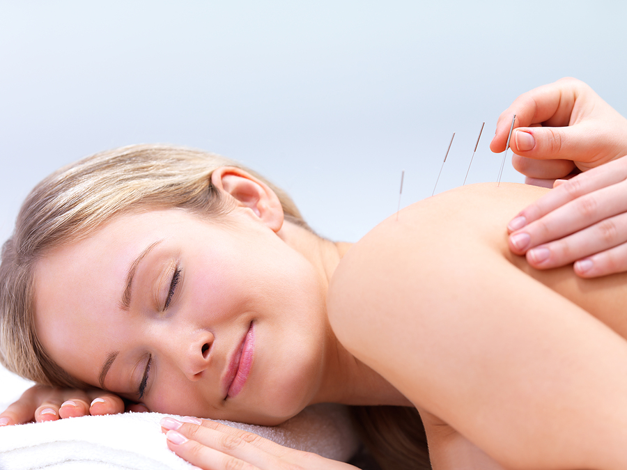 A person having acupuncture treatment for back pain