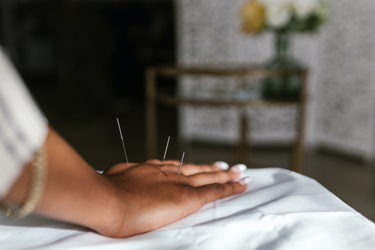 Close-up photo of hands with acupuncture needles inserted into specific points.
